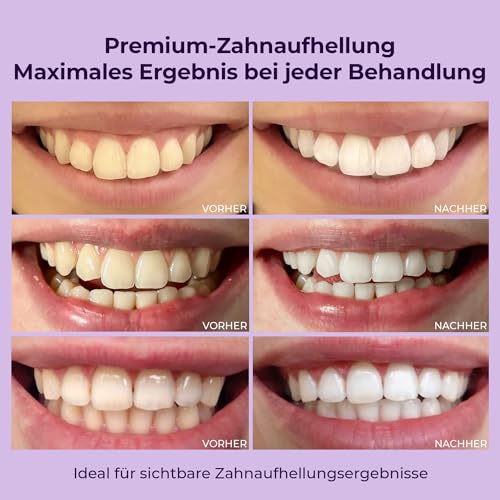 Bleaching-Gel Onlysmile Teeth Whitening Gel für weiße Zähne