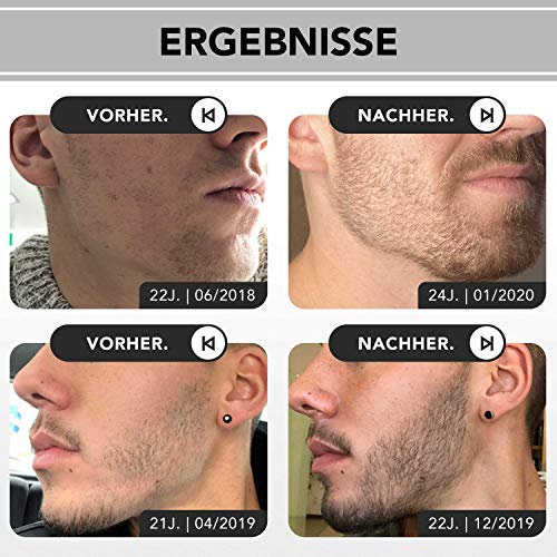 Bartwuchsmittel ANTHONY BROWN ® Öl Beard Growth Kit – Geld zurück